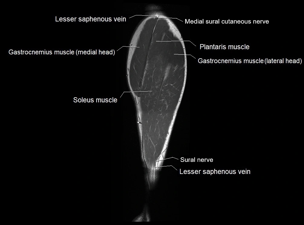 MRI 3T leg (tibia & fibula) labelled coronal cross sectional anatomy image 26.webp